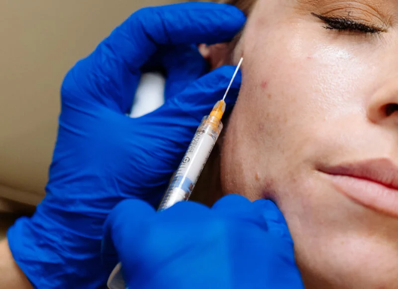 Dermal fillers