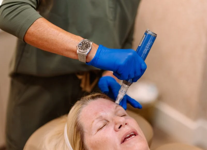 Microneedling and PRP