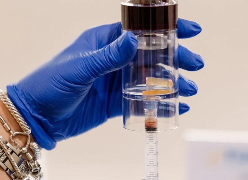 Platelet-rich plasma (PRP)